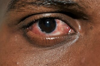 Conjunctivitis (pink eye) affects the outer membrane of the eyeball and the inner eyelid. PHOTO: SUPPLIED